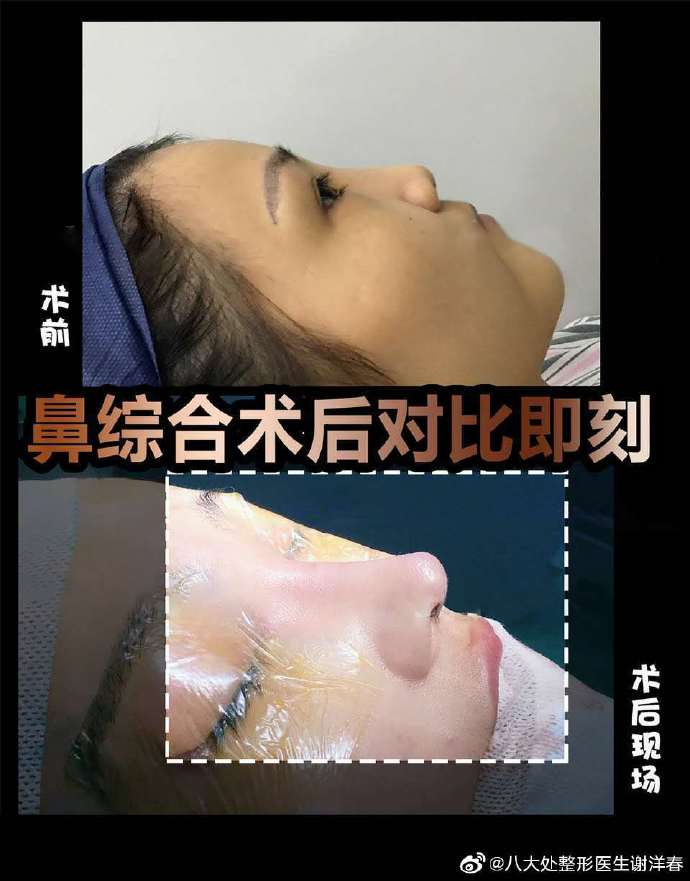 谢洋春鼻综合案例